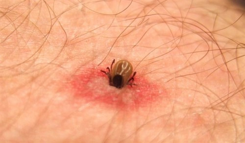 夏天"虫咬"需警惕 严重可致病危