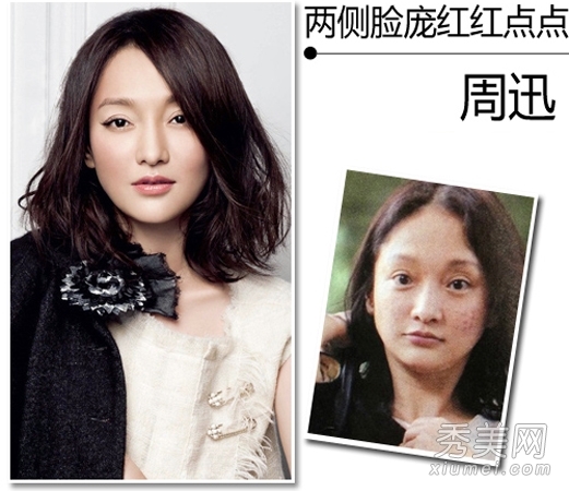 Selina肿成面包 女星过敏烂脸太恐怖 周迅化妆后的照片依旧可以看到痘印和色斑,年轻时各种熬夜、抽烟、饮酒导致皮肤加速衰老,暗黄的肌肤,还有各种皮肤问题真不是女神该有的,提醒各位女生们想要皮肤好一定要养成良好生活习惯。