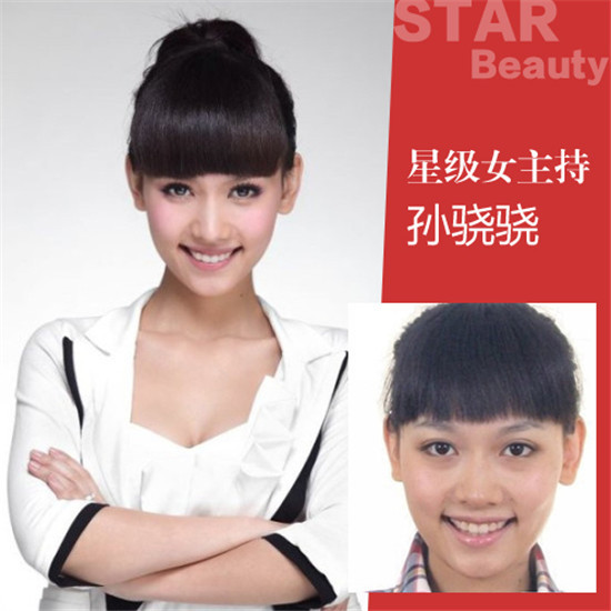 沈梦辰杜海涛恋情曝光前,很多人都不知道这个女孩,主持完《我是歌手3》巅峰会后,一时间声名鹊起,上网的人都认识她了。最近又因整容炒的火热,上哪都能看到她的新闻,让人不得不感叹,原来整容也能整出名啊!编辑我已对这个看脸的世界表示绝望了。 整容整得好,可以少奋斗十年。沈梦晨当年的长相还算清秀,可是肉肉的脸蛋小小的眼睛跟现在的女神模样完全不搭边,现在的她不仅变好看了,而且变年轻了有米有。且让我为大家一一分析她面部的整容疑点。